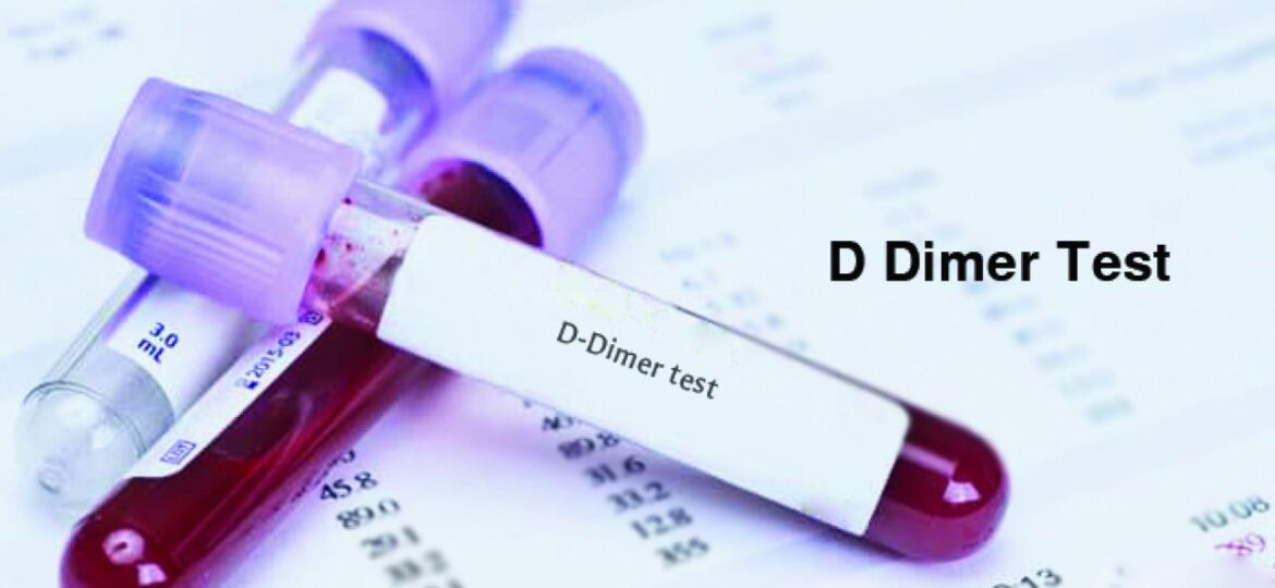 D-Dimer-Test-1280x720