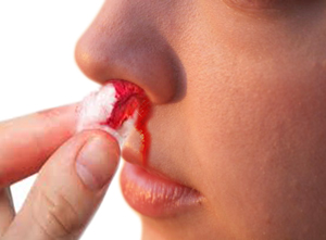 Epistaxis