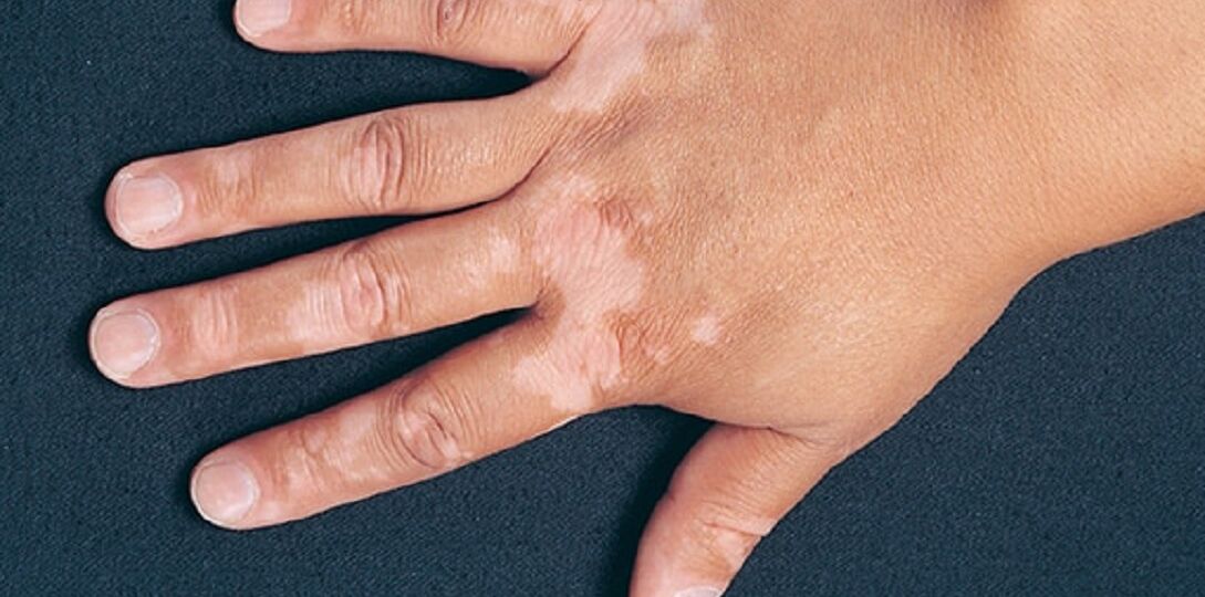 vitiligo (1)